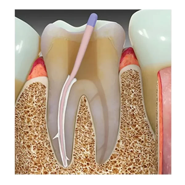Prime Dental Rc Seal Plus - Image 6