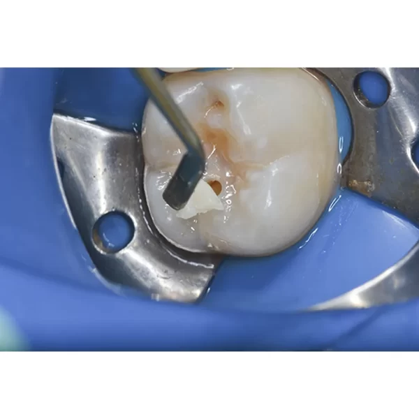 Prime Dental Restorite Micro Hybrid Kit - Image 2