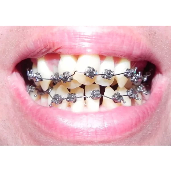 D-Tech Precimax (MIM MBT Prescription Brackets) - Image 2